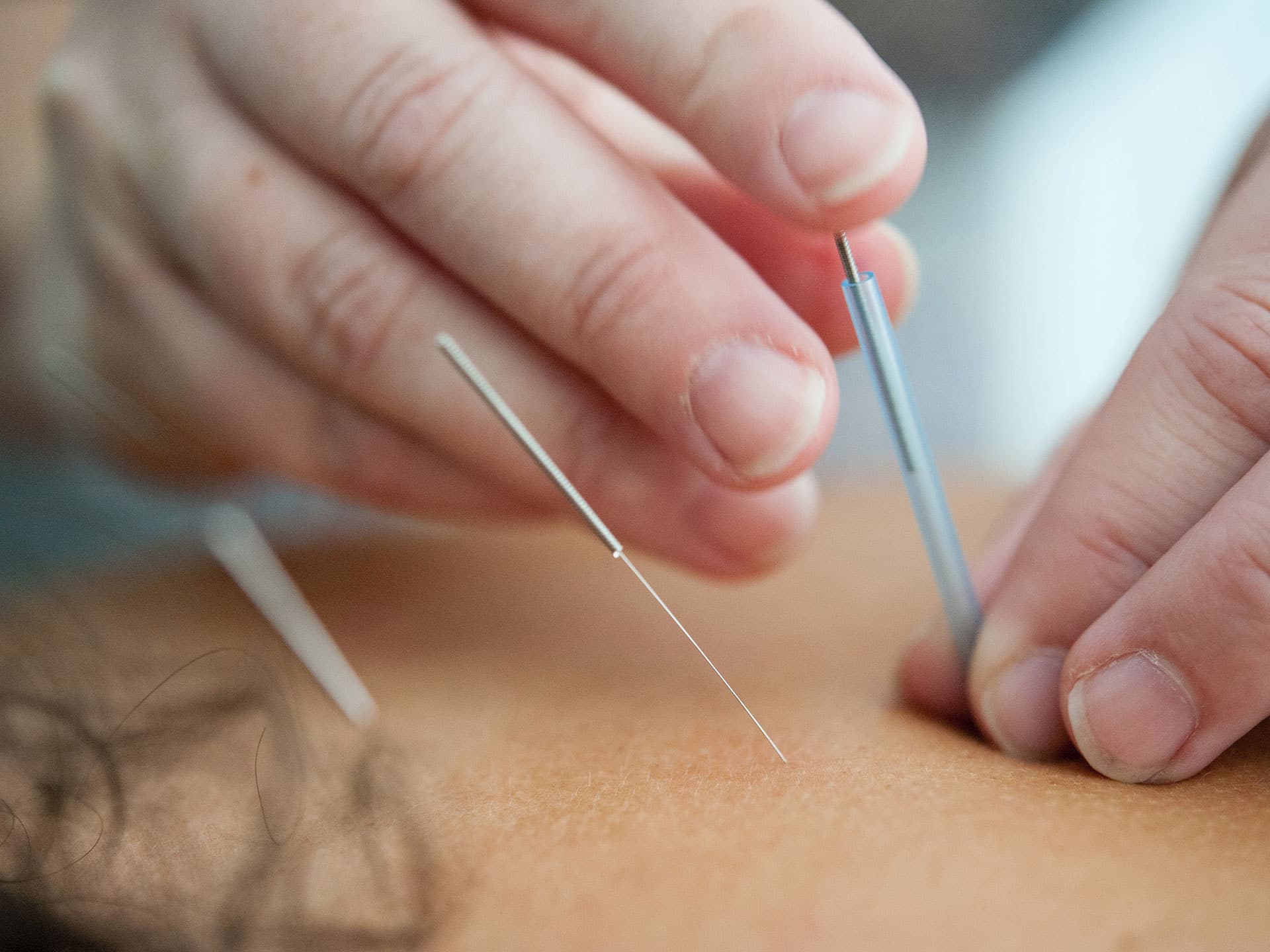 El Akupunktur/Dry-needling